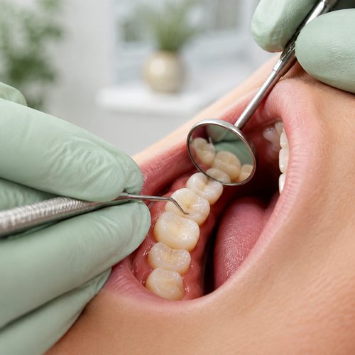 Dentist examining a filled molar